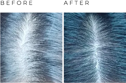 before after balding