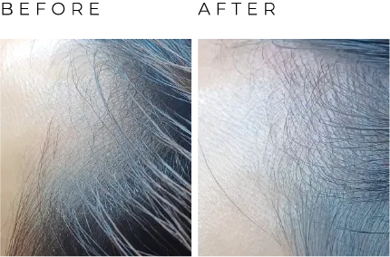 before after balding